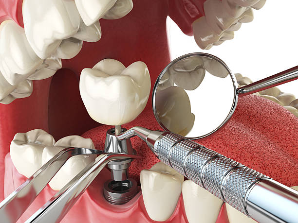 Best Emergency Root Canal Treatment in North Bethesda, MD